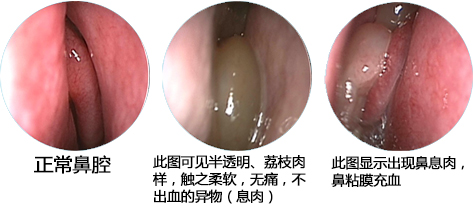 鼻息肉手术价格